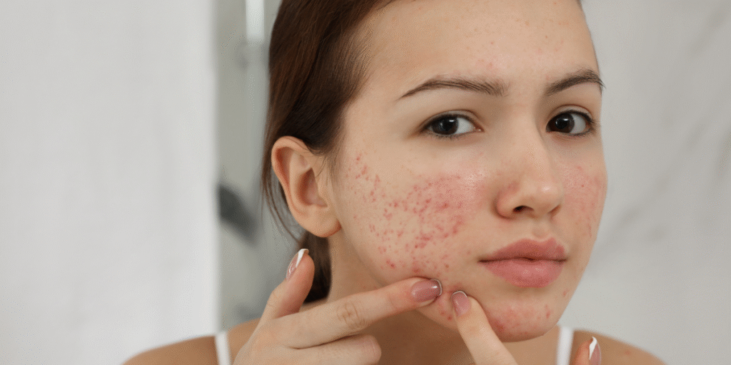 The Best Skincare for Acne-Prone Skin Effective Acne Treatments and Prevention