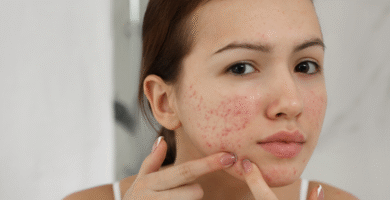 The Best Skincare for Acne-Prone Skin Effective Acne Treatments and Prevention