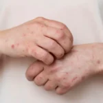 what to do after measles exposure Sydney