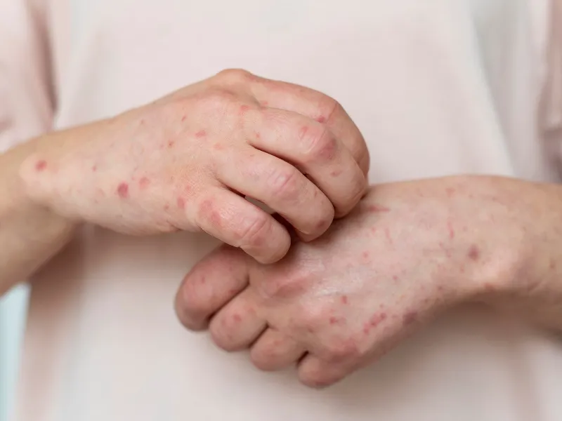 what to do after measles exposure Sydney